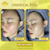 chemical peel