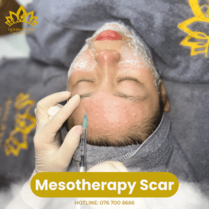 mesotherapy scar
